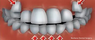 cheap orthodontics treatment hoppers crossing