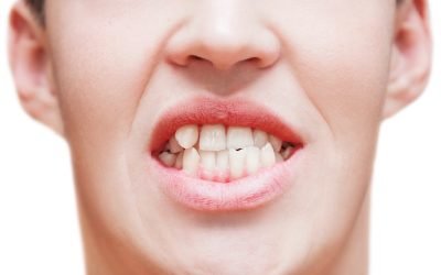 Dental Tips: How Can Orthodontic Fix Crooked Teeth?