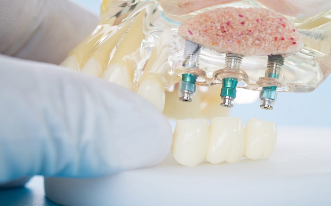 dental implants