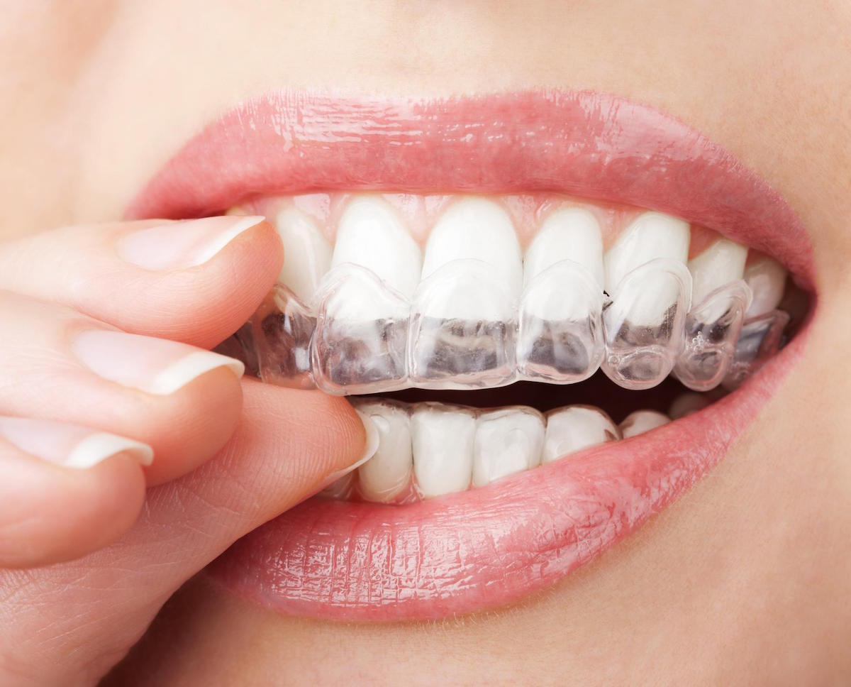 invisalign hoppers crossing