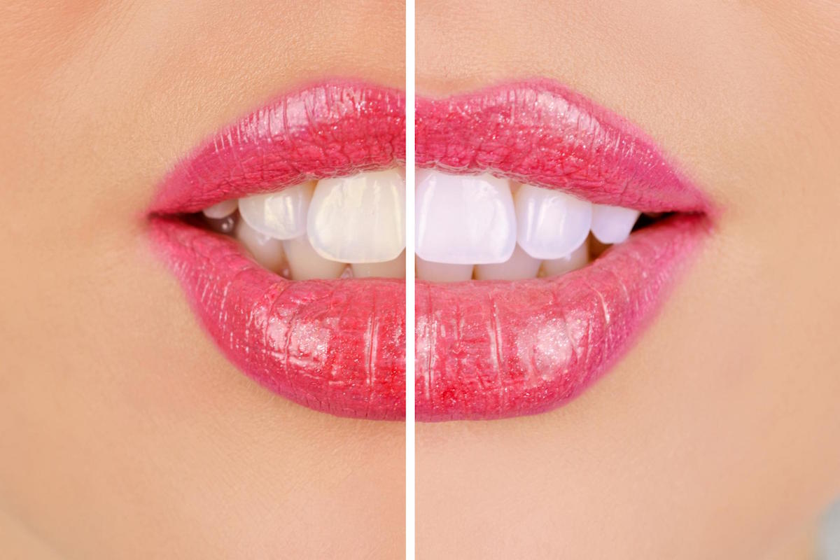 zoom whitening