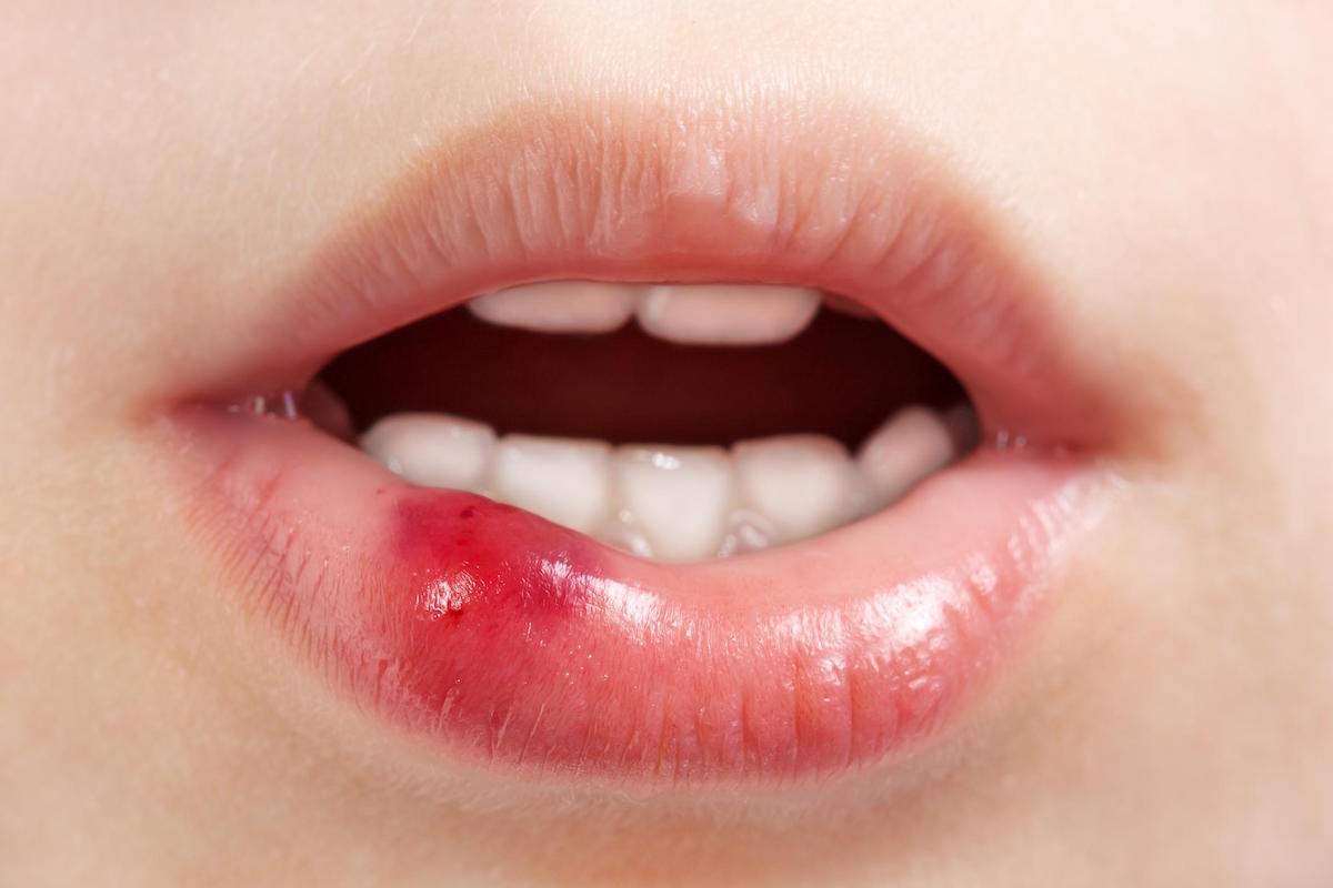 soft tissue injuries in the mouth hoppers crossing