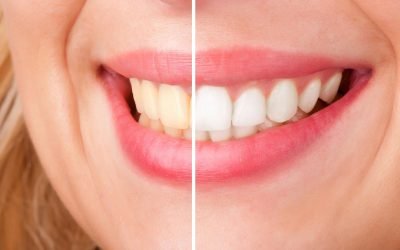 Dental Tips: Over-the-Counter vs Professional Teeth Whitening