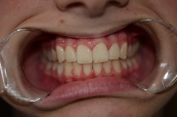 orthodontics case 1 after hoppers crossing