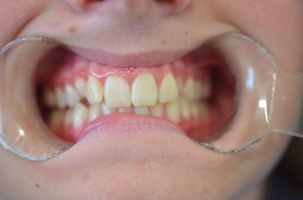 orthodontics-case-1-before-hoppers-crossing