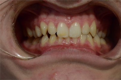 orthodontics case 5 image 3 dentist hoppers crossing