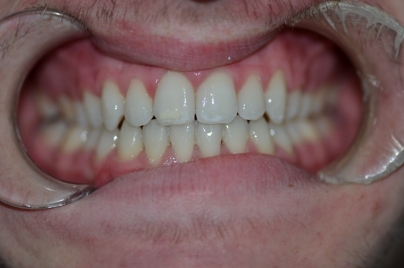 orthodontics case 5 image 4 dentist hoppers crossing