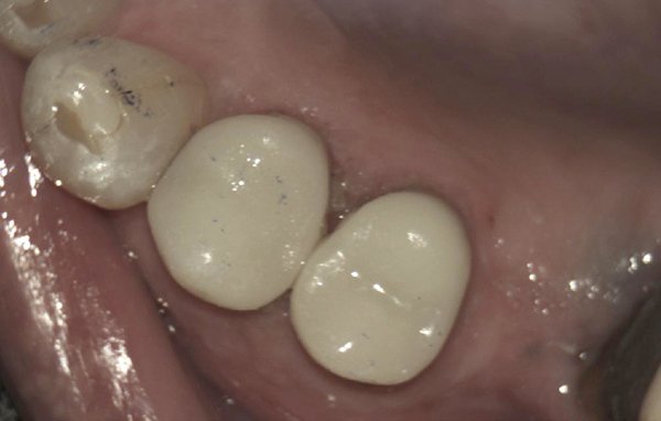 same-day cerec crowns case 1 image 2 dentist hoppers crossing