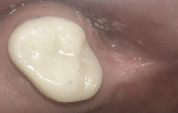 same-day cerec crowns case 3 image 2 dentist hoppers crossing