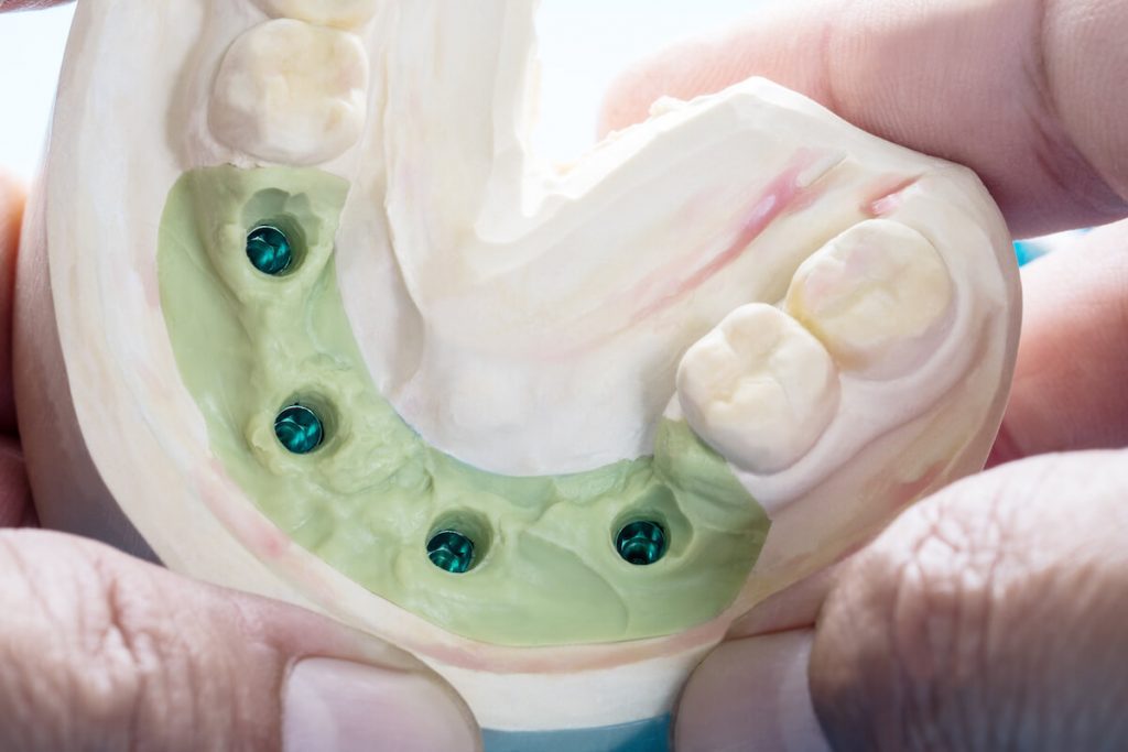 dental implants in hoppers crossing should you shop around