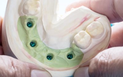 Dental Implants in Hoppers Crossing: Should You Shop Around?