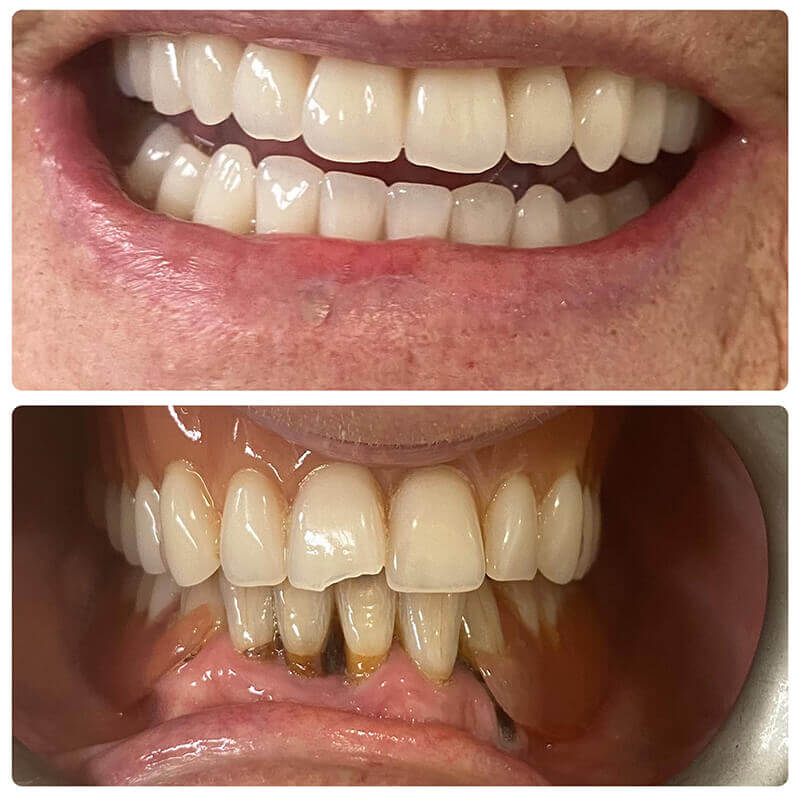 upper denture and lower fixed bridge on 4 implants hoppers crossing